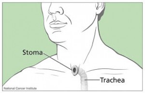 Tracheal/Stoma