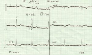 EKG